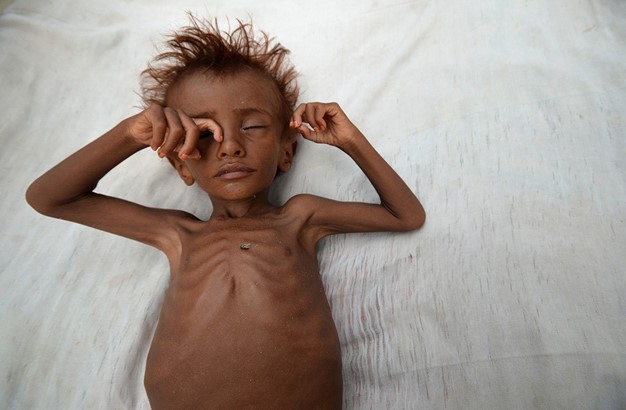 نفي لأي تقدّم للتحالف في الحديدة... و400 ألف طفل يمني مهددون بالموت