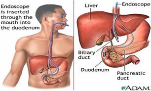 ERCP چیست ؟