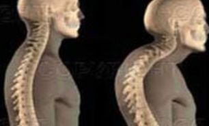 شنا و بارفیکس دشمن اصلی کیفوز