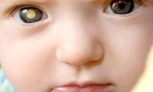 انحراف چشمی را جدی بگیرید