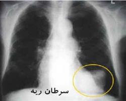 آقایان خطر ابتلا به سرطان ریه را جدی بگیرند
