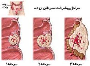 سرطان کلون و رکتوم و علائم آن