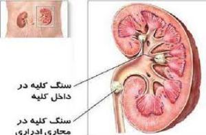 سنگ کلیه، علائم آن و راه های پیشگیری