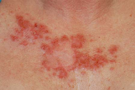ملاسما Melasma چیست؟