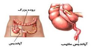 آپاندیسیت چیست؟