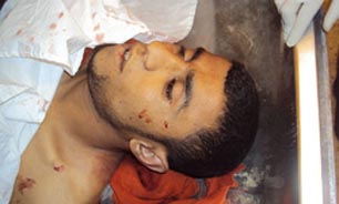 معلولیت زندانیان در اثر شکنجه در زندان هاي رژیم آل سعود