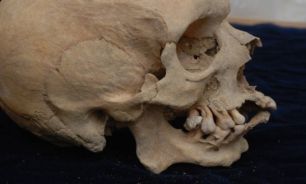 نمایش اولین مته کاری در جراحی جمجمه