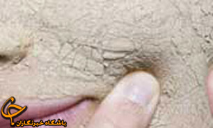 نتایج رضایت بخش در جوانسازی صورت با ژل هیالورونیک اسید