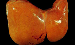 بیماری کبد چرب در زنان شایع تر از مردان است
