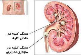 سنگ مثانه چیست؟