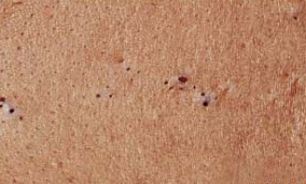 چگونه از شر جوش هاي سرسياه خلاص شويم؟