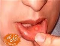 اگر شما هم دچار آفت دهان هستید این مطلب را حتما بخوانید