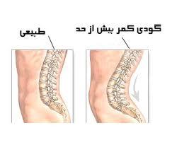 گودي‌كمر ارتباطي با كمردرد ندارد