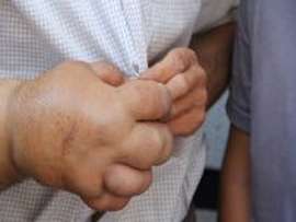 زندگی با دست 5 کیلویی