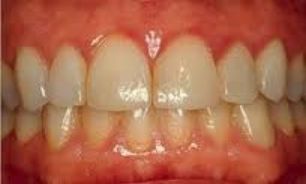 بيماري لثه نتيجه بهداشت ضعيف دهان و دندان است