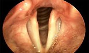 تارهای صوتی مصنوعی می آیند+عكس