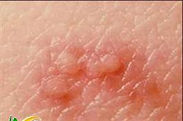 بروز تاول های قرمز و دردناک در امتداد رشته های عصبی از علائم زونا