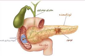 غربالگری و تشخیص زودرس راهکاری اساسی در افزایش موفقیت درمان سرطان