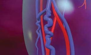 گرفتگی عضلات پا در خواب شب!