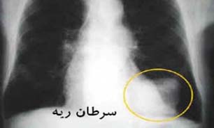 سرطان ریه با قطع استعمال دخانیات قابل پیشگیری ترین سرطان است