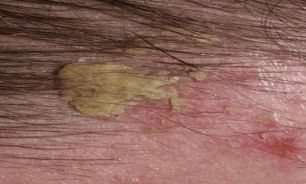درماتیت سبوره، عودکننده است