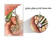 پیشگیری از تشکیل سنگ ها ی صفراوی