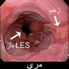 تغذیه در زخم مری
