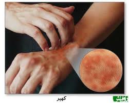 چگونه از سرطان پوست جلوگیری کنیم؟