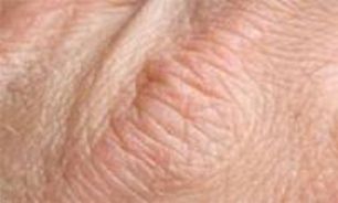 دلایل خارش پیری Senile Pruritus چیست؟