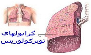 تعداد 330 مسلول در استان كرمانشاه شناسایی شدند