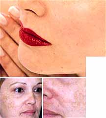 خال‌ های پوستی را برندارید