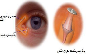 خشکی چشم چیست؟