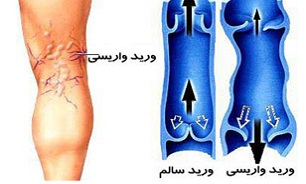 ایستادن یا نشستن های طولانی مدت باعث ایجاد «واریس» می شود