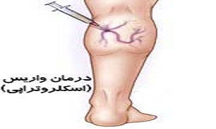 نشستن زیادی باعث واریس می میشود