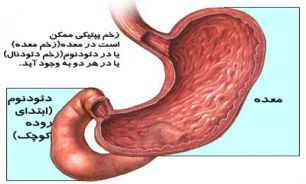 درباره زخم پپتيک چه مي دانيد!