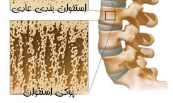 همایش پوکی استخوان در اردبیل برگزار شد