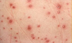 خطر ابتلا به زونا در چه افرادی بیشتر است؟