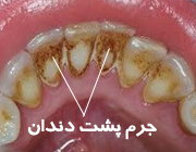 اگر دندان‌تان را جرم‌گیری نکنید چه می‌شود؟
