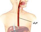 عفونت دندان و خطر ابتلا به سرطان مری