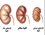 نارسایی کلیه خبر نمی‌کند