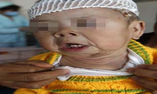 کودک يک ساله‌اي که 80 ساله به نظر مي‌رسد