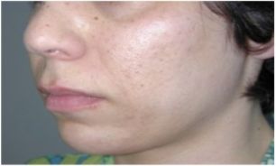 کرم پودرهای چرب برای آکنه مناسب نیست