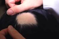 عامل اصلی ریزش سکه ای موی سر چیست؟