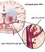 چگونه سکته مغزی را تشخیص دهیم