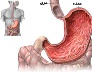 عفونت درکمین معده