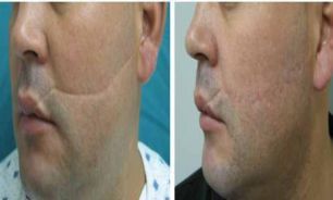 چگونه از ایجاد جای زخم جلوگیری کنیم؟