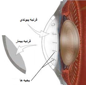 مراقب چشمانتان باشید تا قوز نکنند