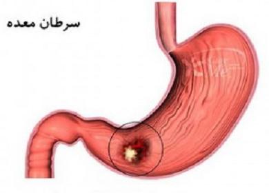 مرگ سالانه بیش از 30 هزار نفر ایرانی بر اثر ابتلا به سرطان معده