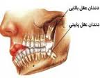 دندان عقل را به حال خود رها نکنید
