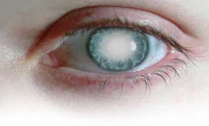 پایین آمدن سن ابتلا به آب مروارید